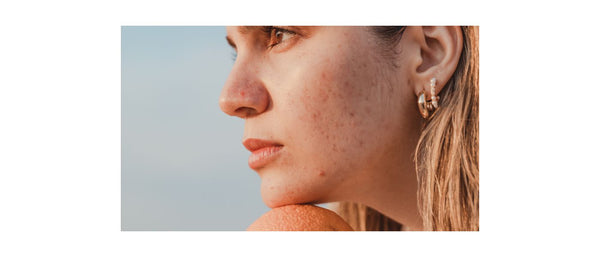 woman with acne on cheeks