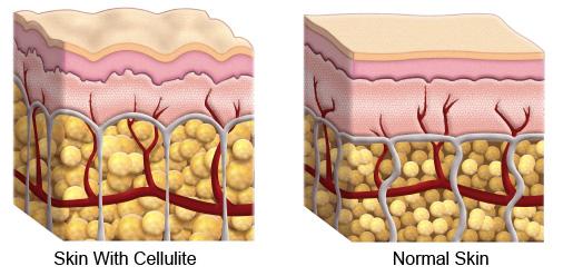 The Secret About Cellulite Is No Secret At All