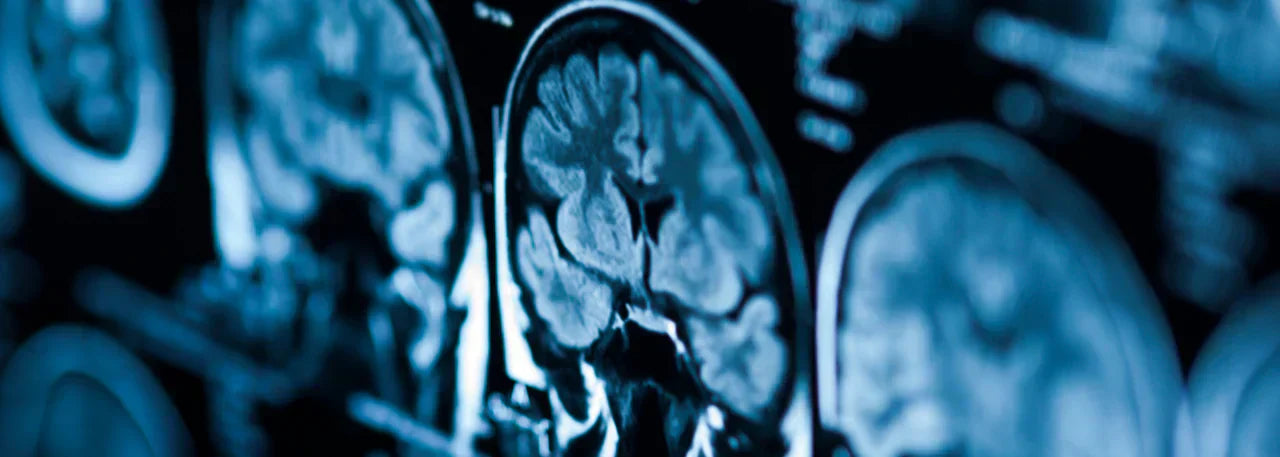 Reversing Cognitive Decline: Why the Vascular System Holds the Key background image