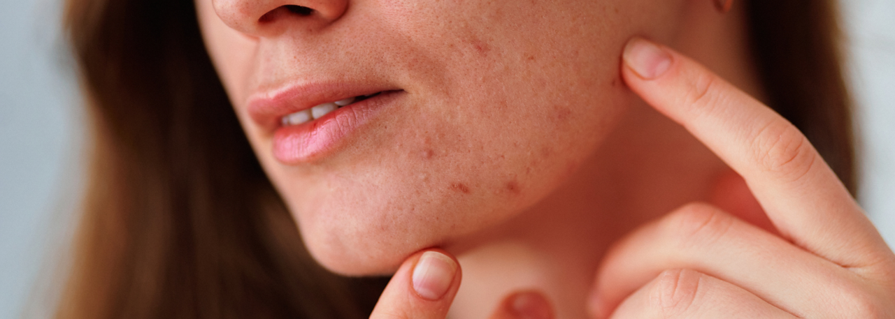 The Ultimate Guide to Hormonal Acne Supplements: Science-Backed Solutions for Clear Skin background image